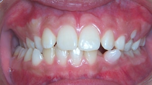 Dental Midlines Lew B. Sample Orthodontics in Hartselle & Decatur, AL