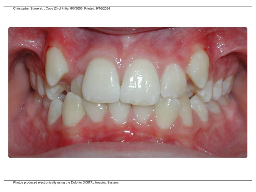 Extractions Valley Orthodontics in Decatur and Hartselle, AL