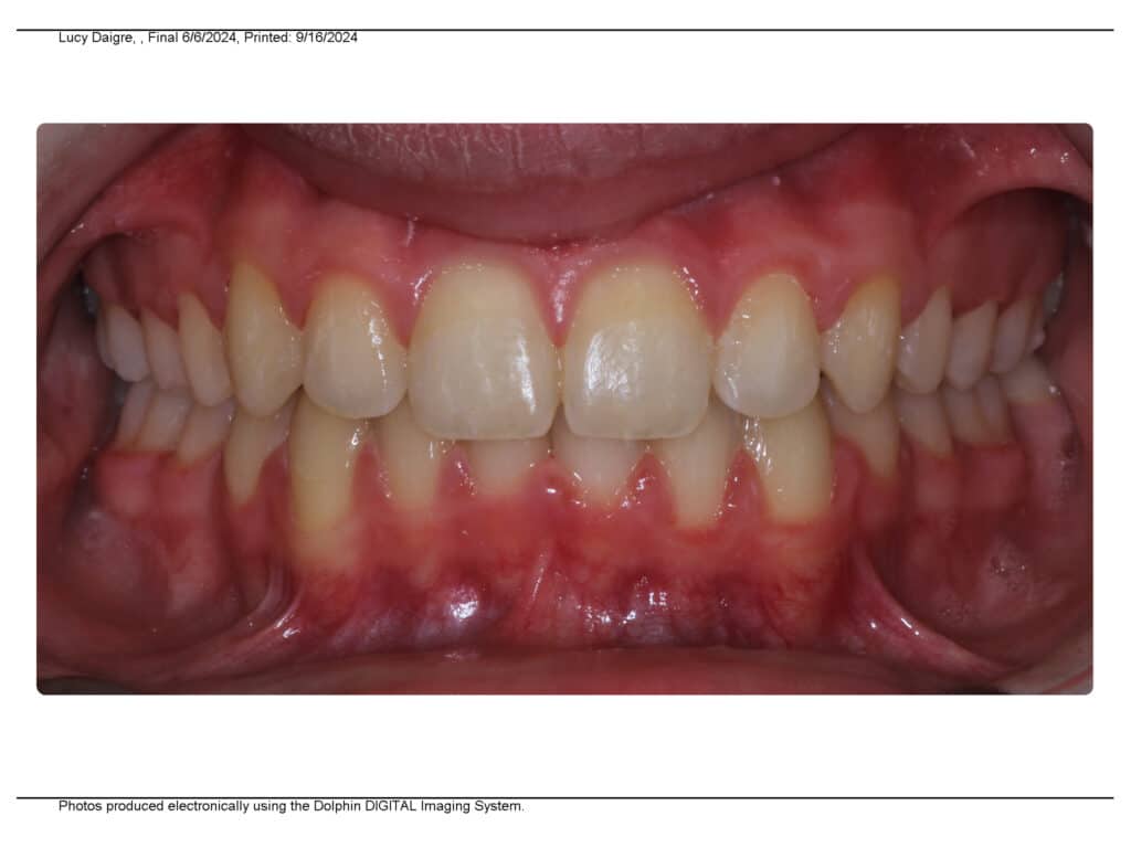 Overbite after Valley Orthodontics in Decatur and Hartselle, AL