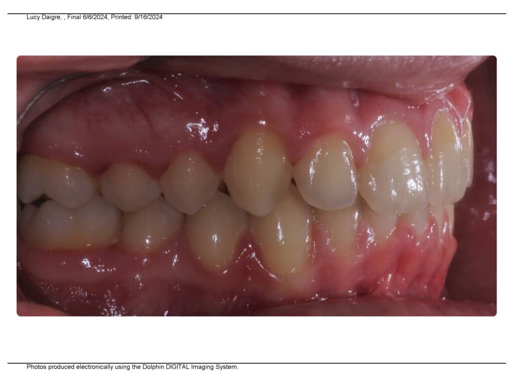 Overbite after Valley Orthodontics in Decatur and Hartselle, AL