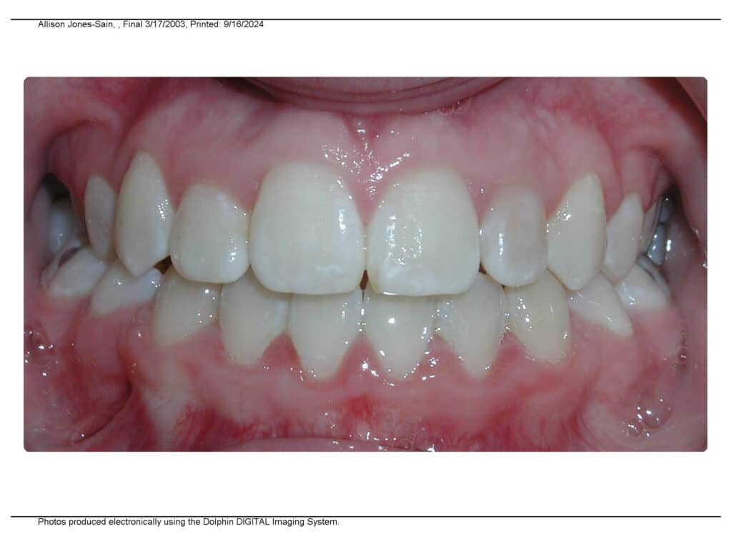 After picture Valley Orthodontics in Decatur and Hartselle, AL